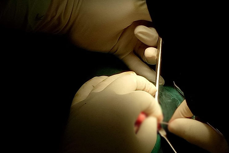 Operasi Laparascopy RSCK Tzu Chi